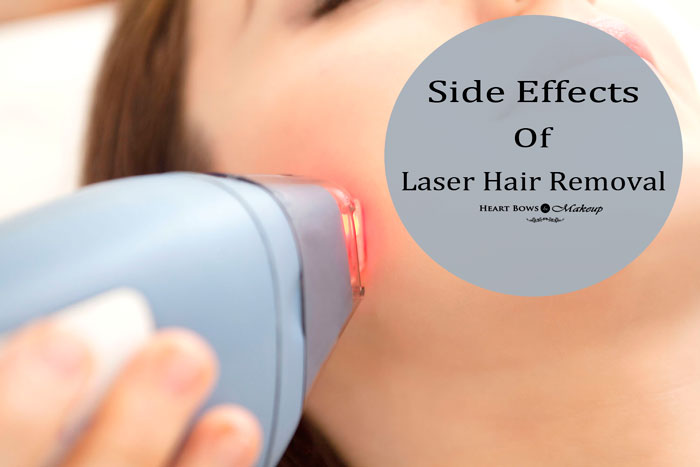 Permanent Laser Hair Removal: Procedure, Side Effects & Cost in India -  Heart Bows & Makeup