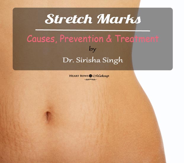 Causes Of Stretch Marks Prevention Cure & Treatment