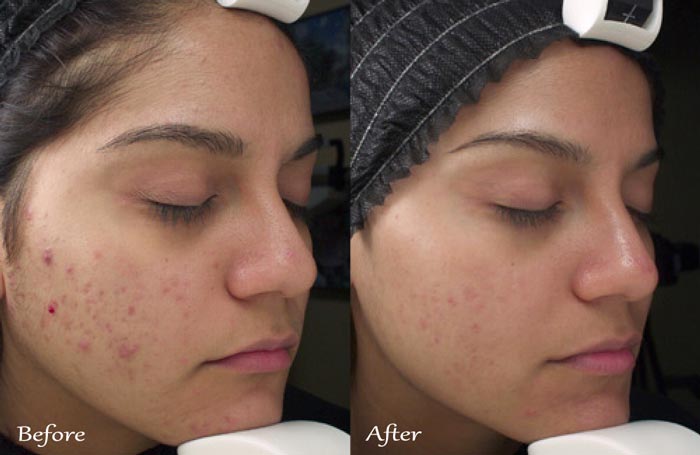TCA Chemical Peel Before & After Acne Scars