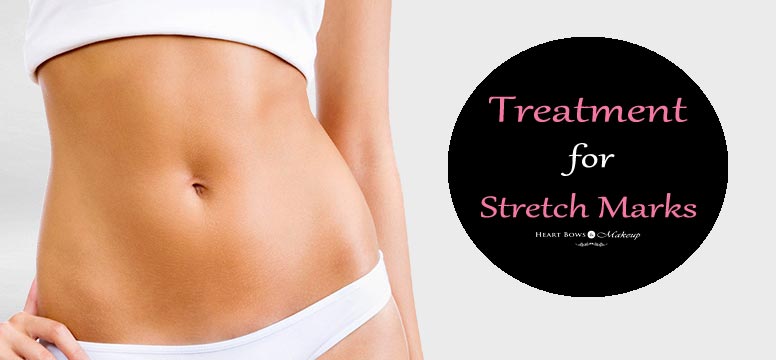 Treatments & Remedies For Stretch Marks