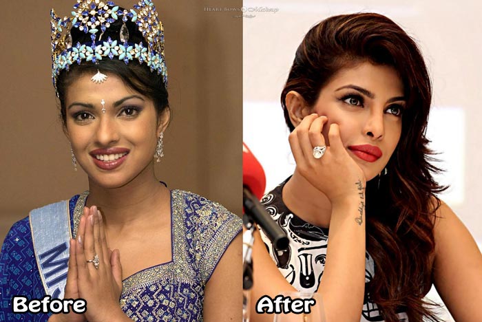 Priyanka Chopra Plastic Surgery Before After Pictures Nose Job