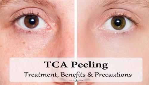 TCA Peeling: Treatment Details, Benefits, Precautions & Side Effects TCA Peeling: Treatment Details, Benefits, Precautions & Side Effects