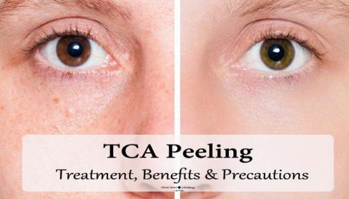 TCA Peeling: Treatment Details, Benefits, Precautions & Side Effects