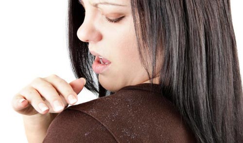 What Causes Dandruff How To Treat It Naturally